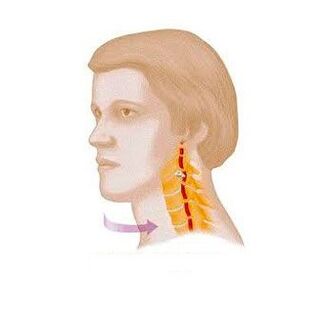 синдроми vertebral бо остеохондрозҳои гарданаки бадан