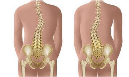 Scoliosis-и бел