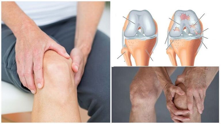 Аломати дарди Knee artrthosk-и пайванди зону